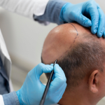 HAIR TRANSPLANT