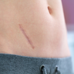 SCAR REVISION