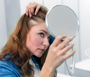 ALOPECIA