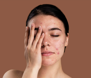 PIGMENTATION