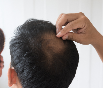 HAIRFALL