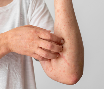 PSORIASIS