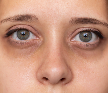 UNDEREYE CONCERNS