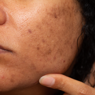 SKIN CONCERNS
